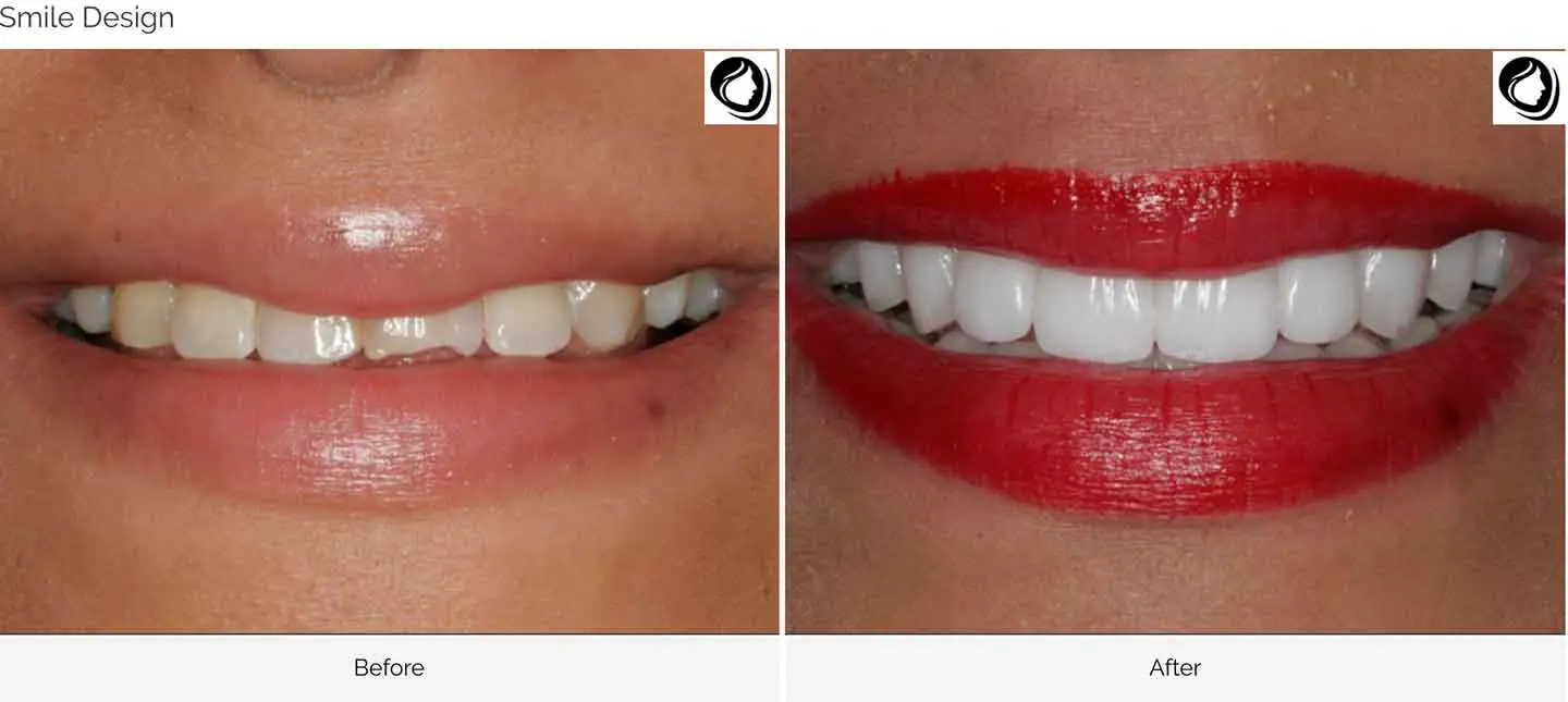 Smile design transformation case 2