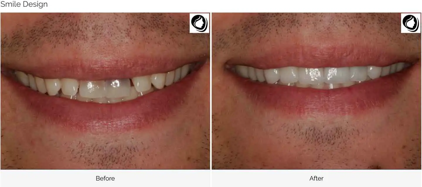 Smile design transformation case 3