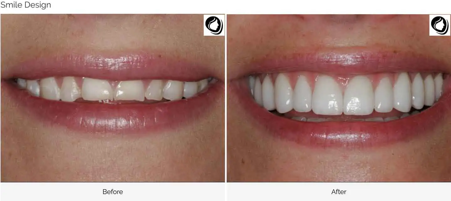 Smile design transformation case 4