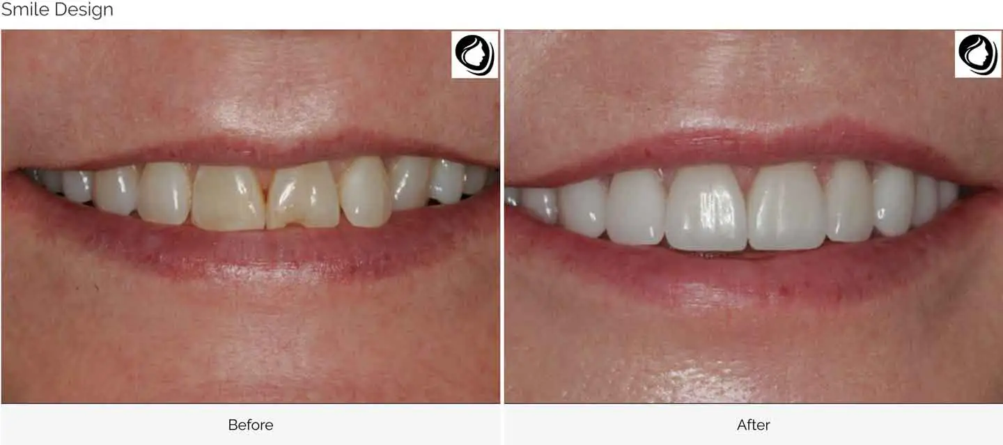 Smile design transformation case 5