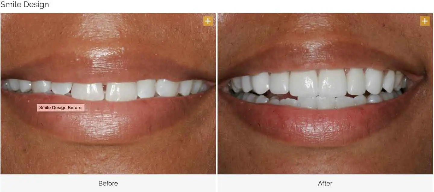 Cosmetic smile transformation