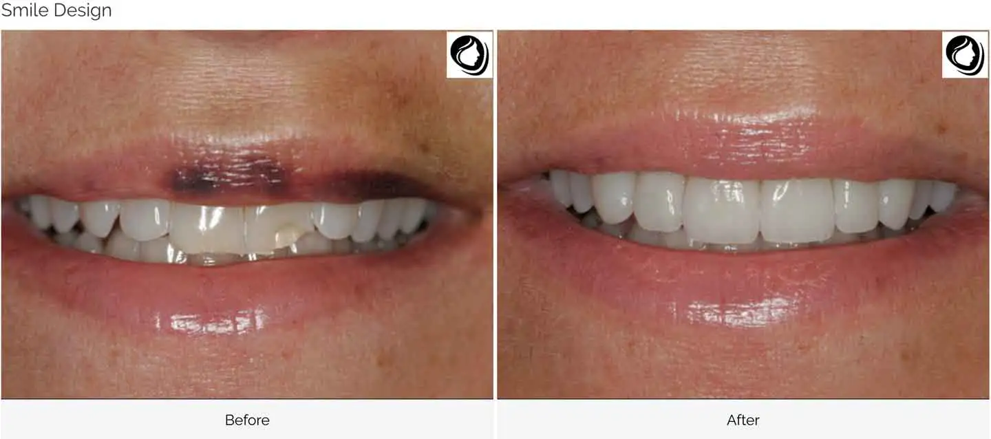 Smile design transformation case 7