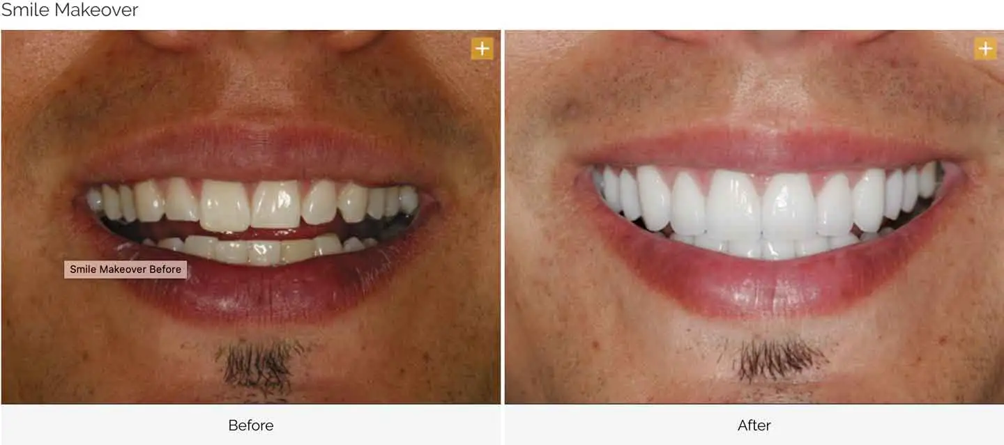 Smile design transformation case 9