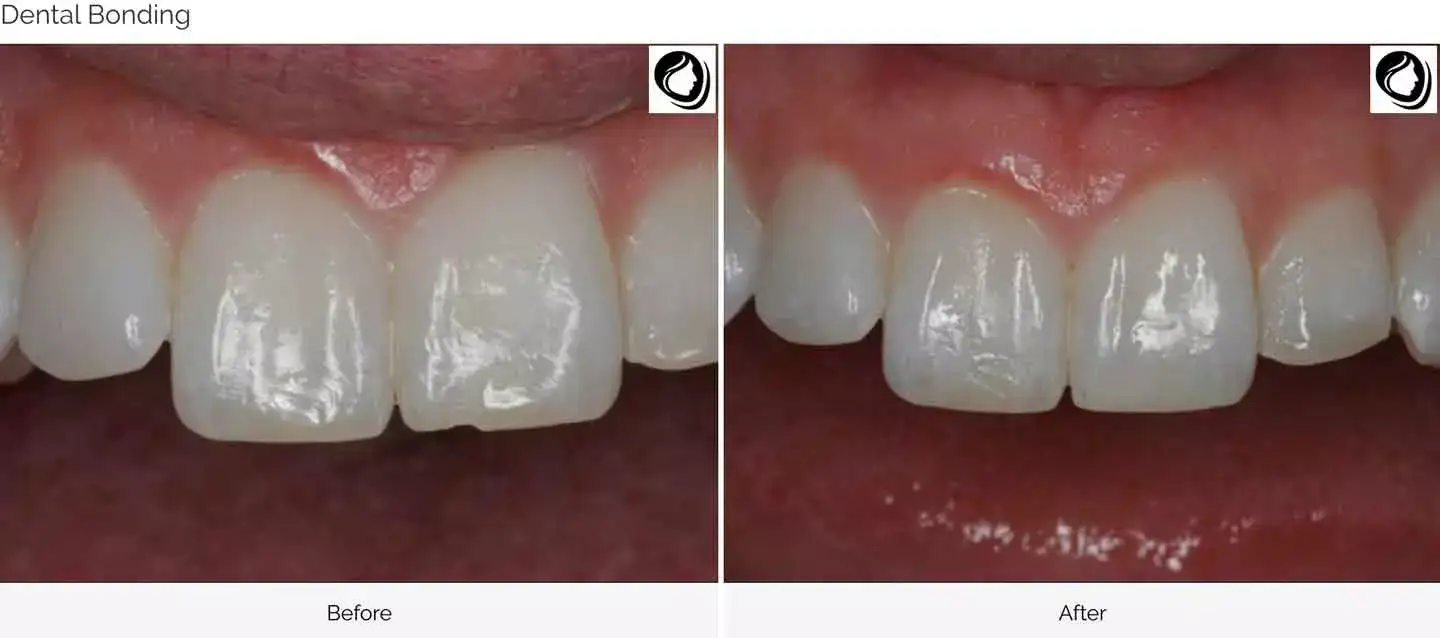 Dental bonding case