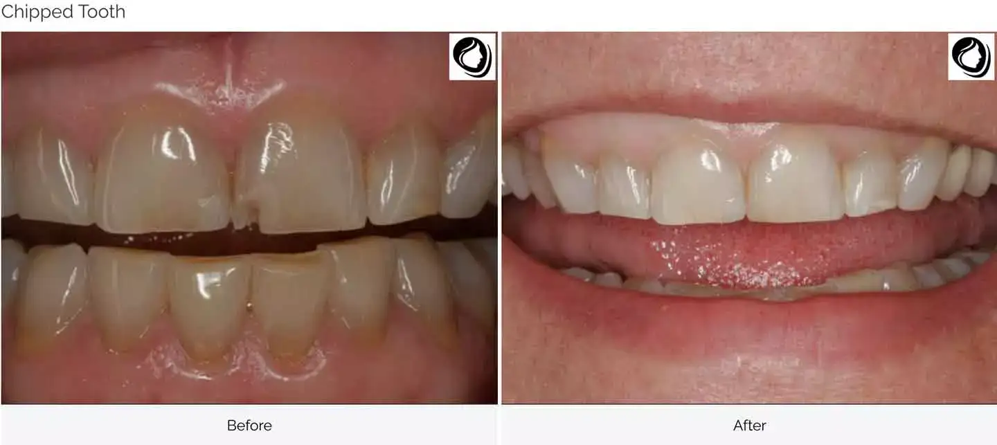 Dental bonding case 2 before and after