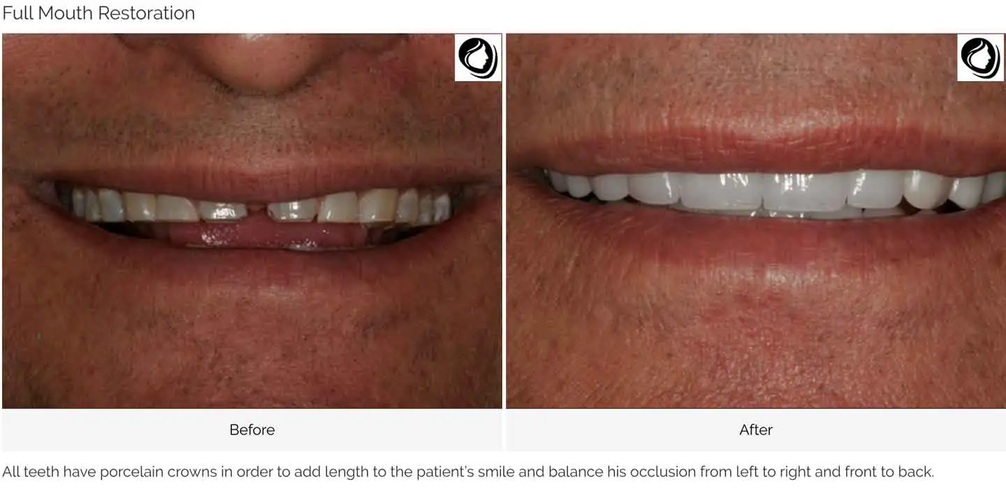 Full mouth restoration