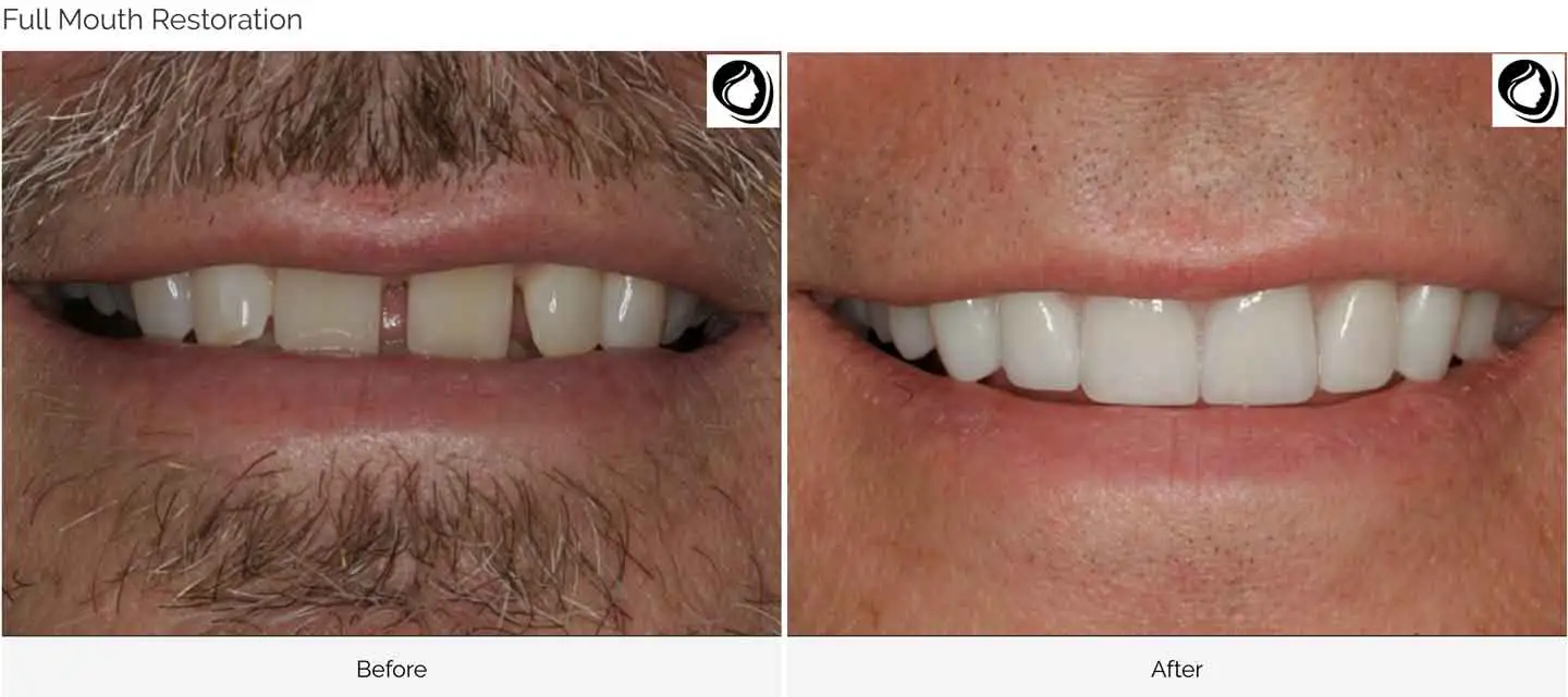 Full mouth restoration case 2 before and after