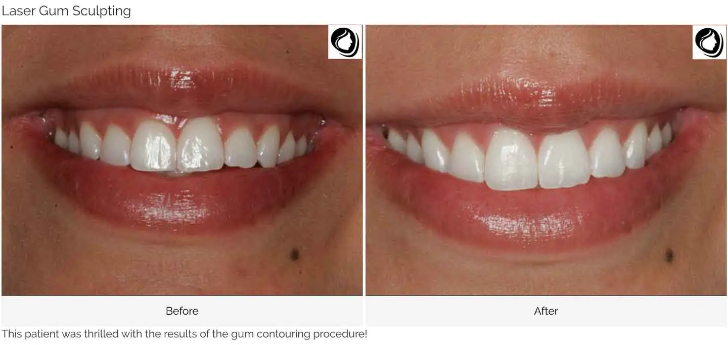 Laser gum sculpting case