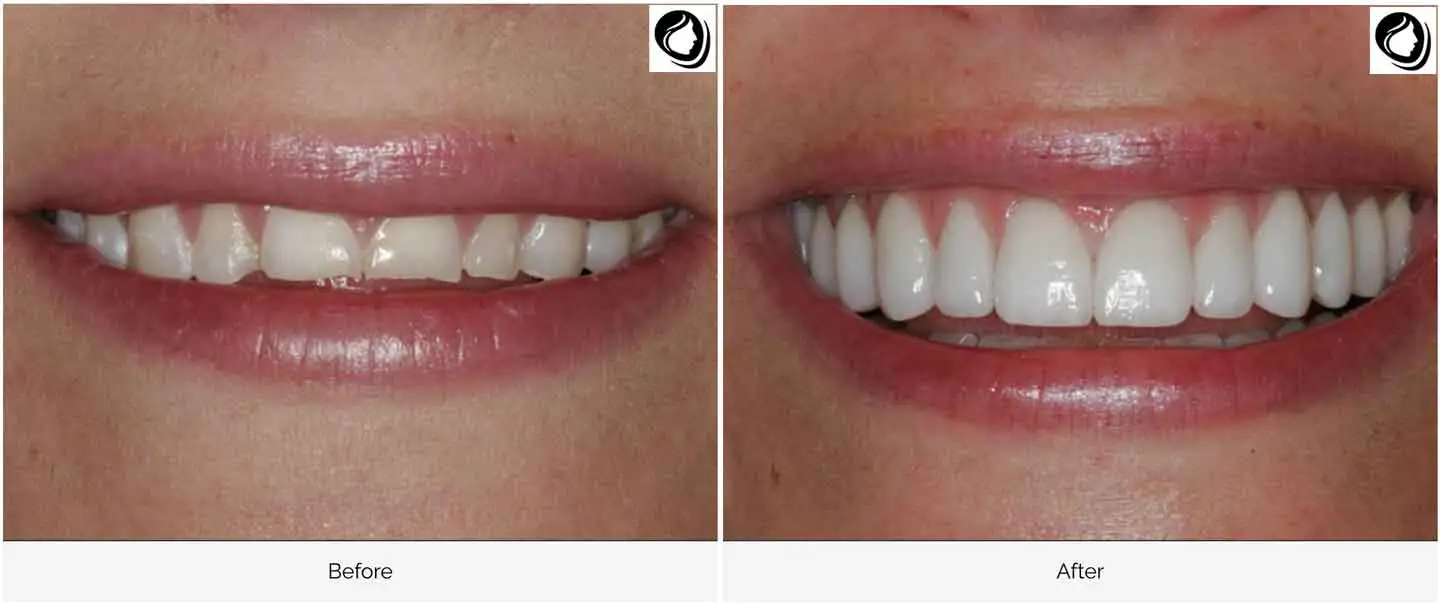 Laser gum sculpting case 2 before and after